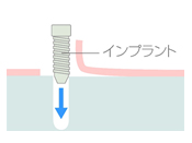 インプラント埋入イラスト