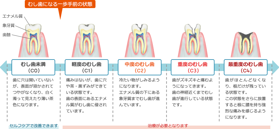 むし歯の進行と症状について