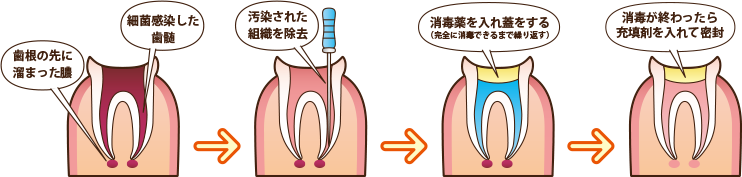 むし歯の進行と症状について