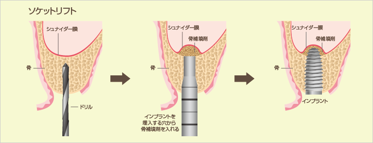 ソケットリフトのイラスト